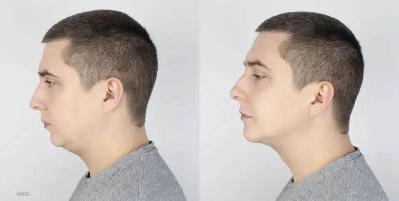Man before and after a chin surgery.