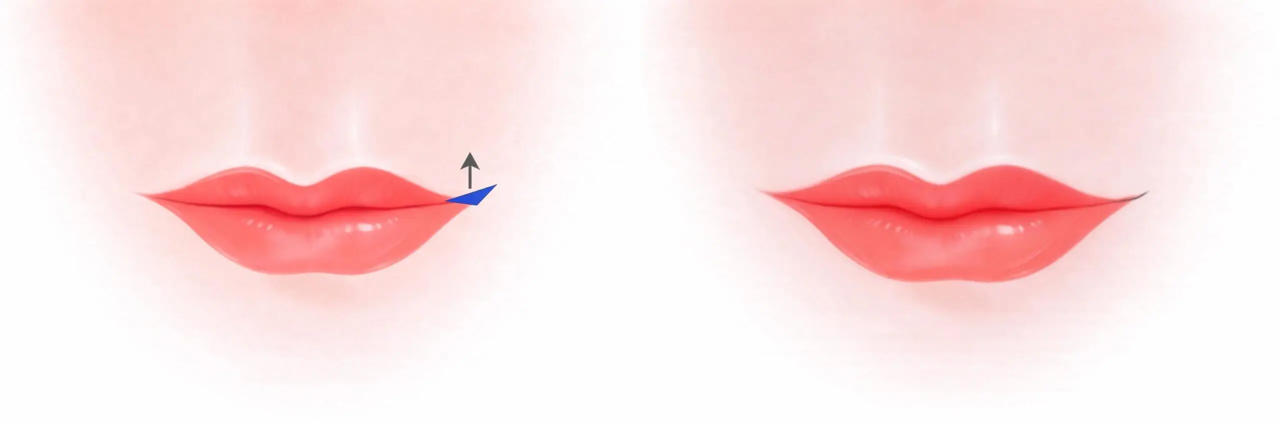 Diagram illustrating the lateral commissure triangle lift, showing the triangular tissue excision above each corner of the mouth to elevate the outer portions of the lip