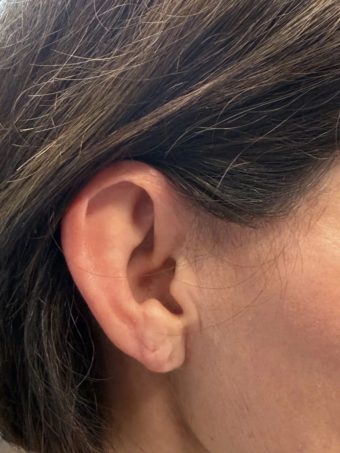 Refined scar detail