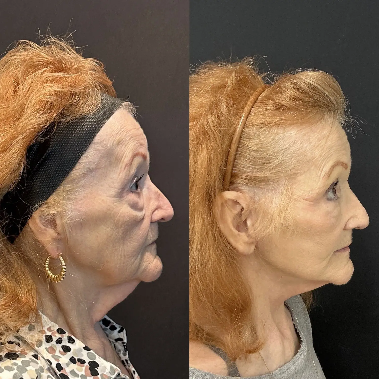 Traditional facelift side view - patient in her late 70s - Dr. Adam Weinfeld Austin