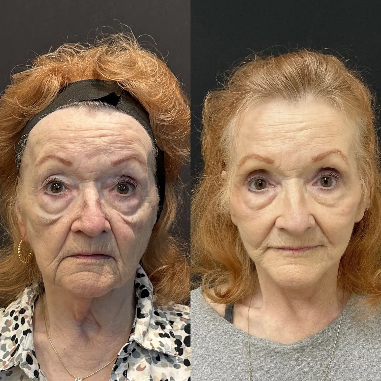 Traditional facelift front view - patient in her late 70s - Dr. Adam Weinfeld Austin