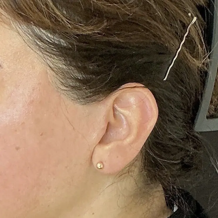 Refined scar detail