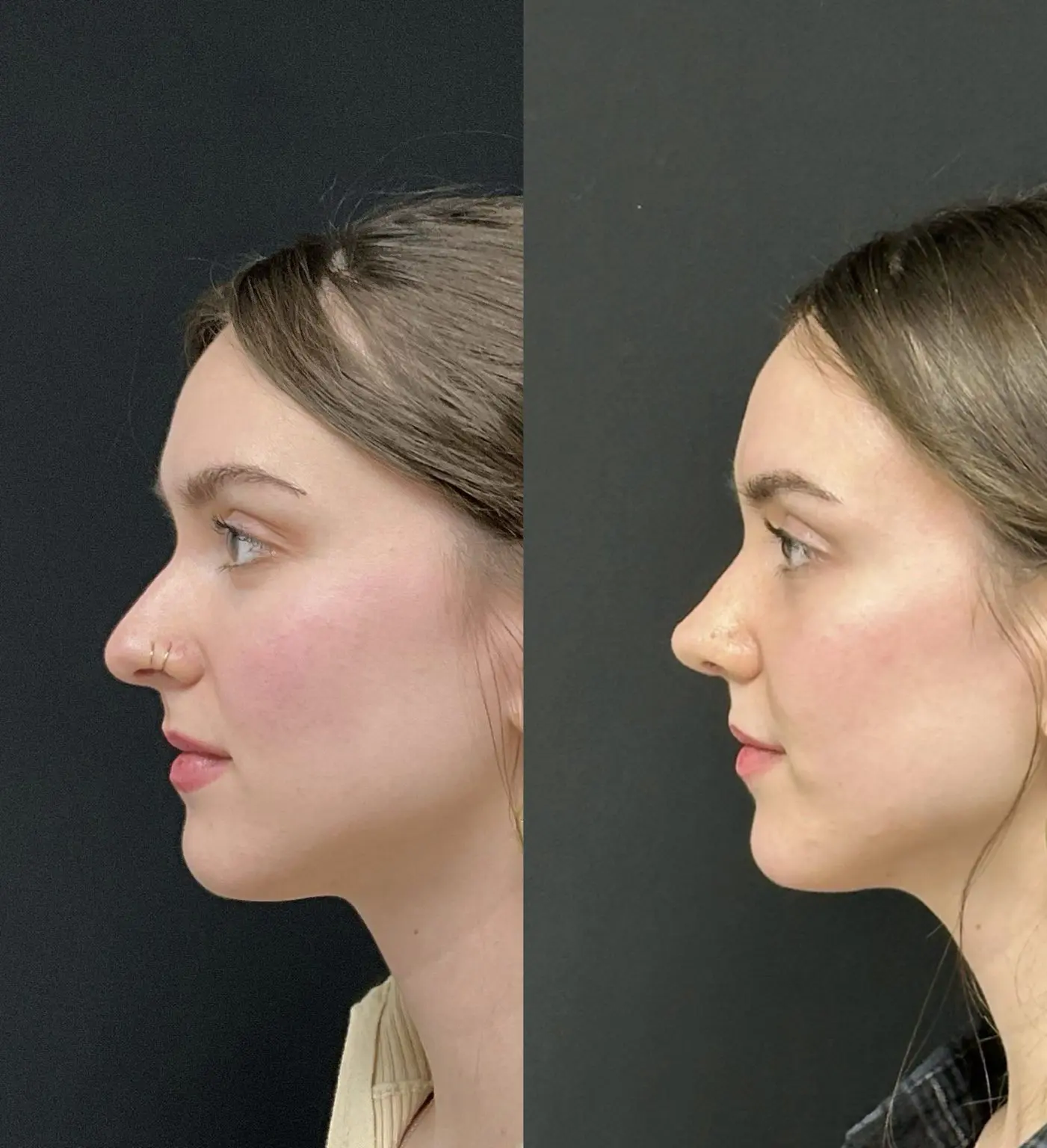 Female open structure rhinoplasty result