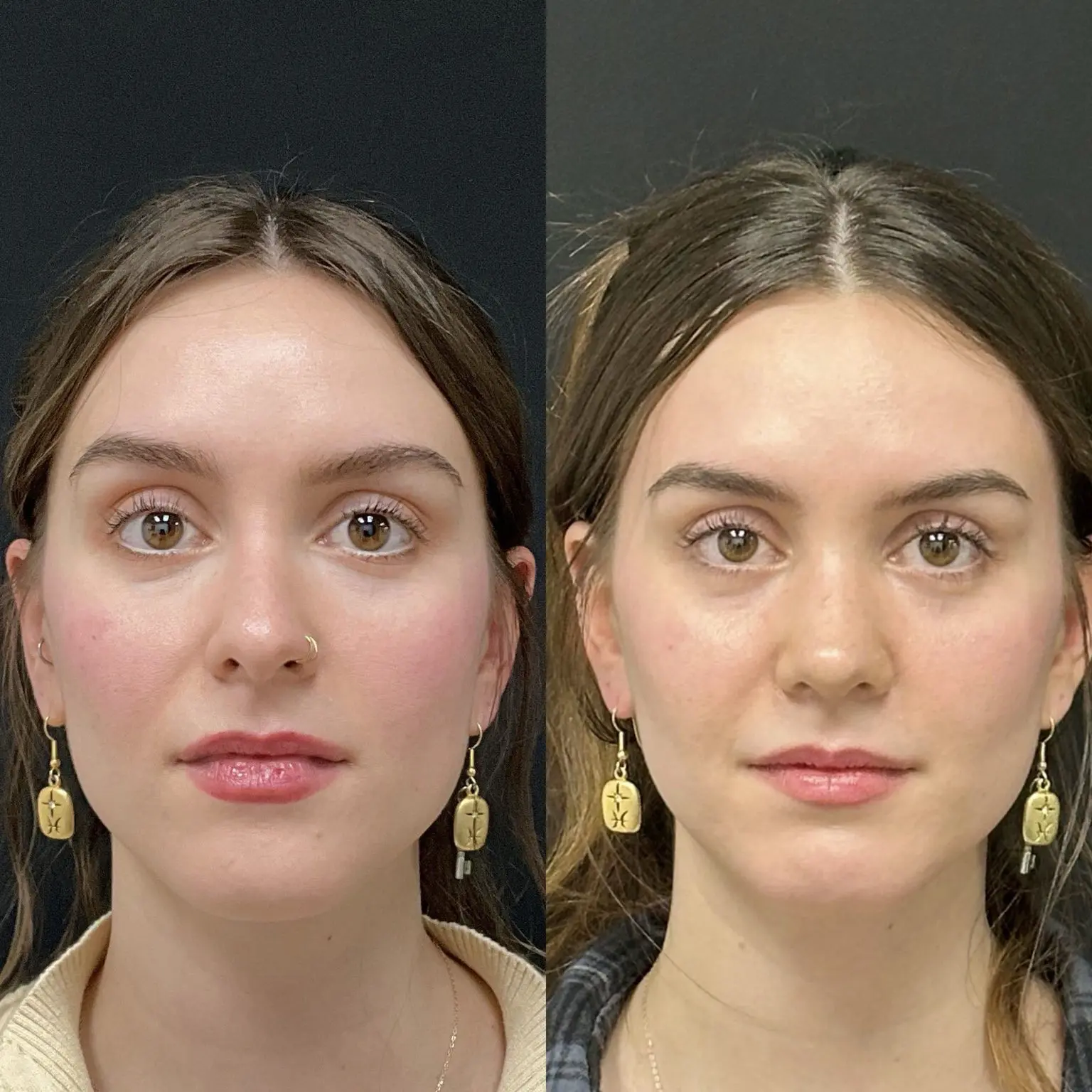 Female open structure rhinoplasty result