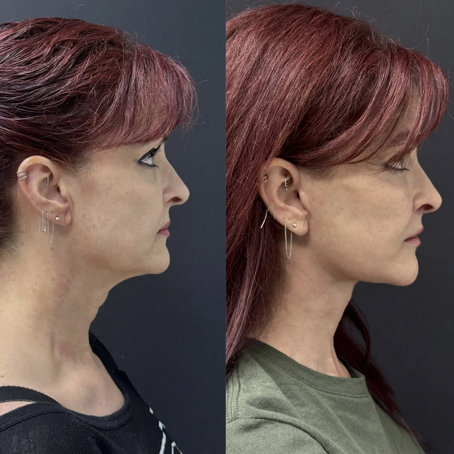 2 months after facelift and laser treatment