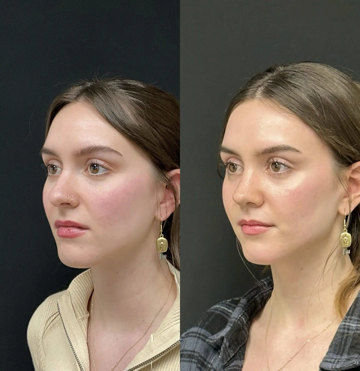 Female open structure rhinoplasty result