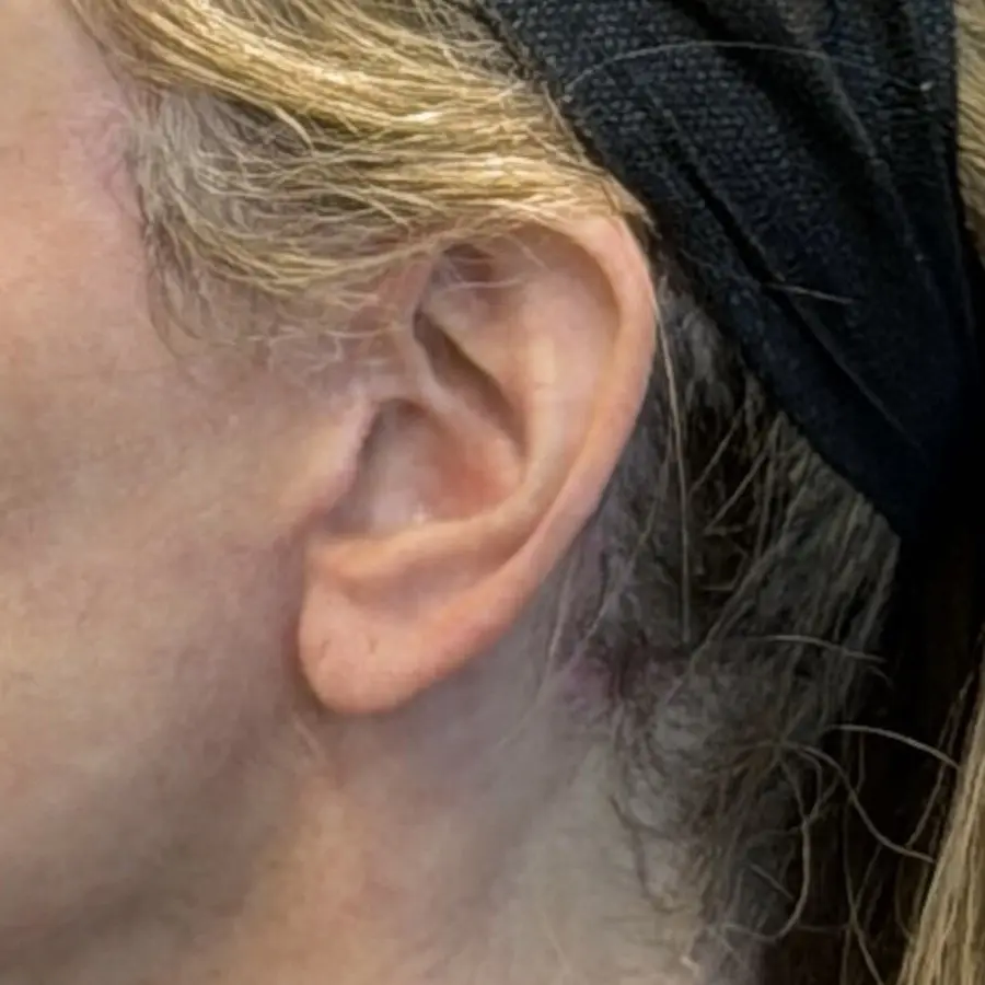 Refined scar detail