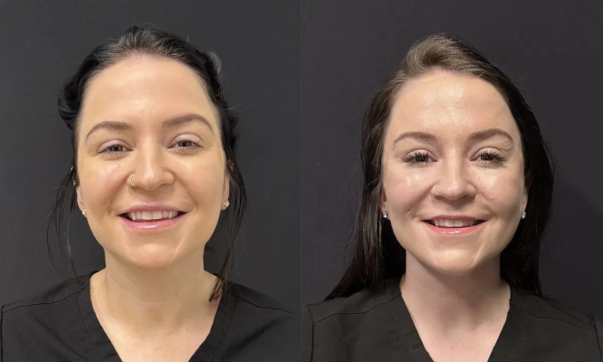 Full endoscopic facelift front view - patient in her 30s - Dr. Adam Weinfeld Austin