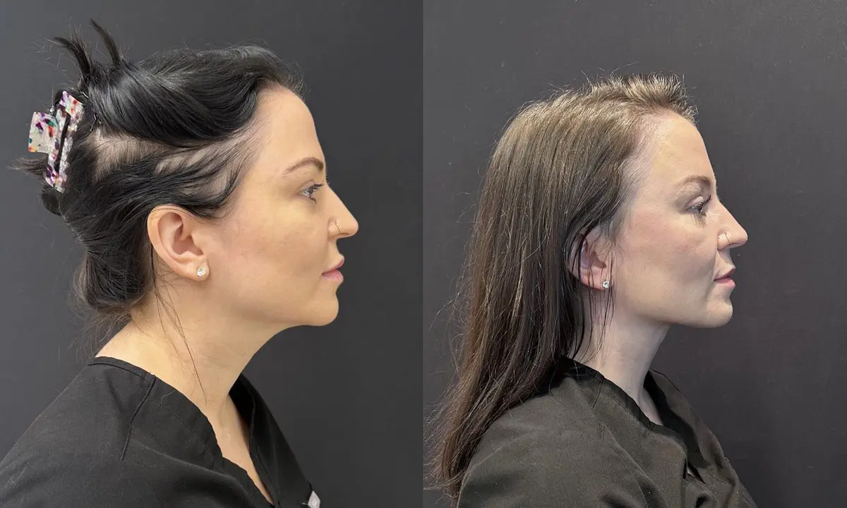 Full endoscopic facelift side view - patient in her 30s - Dr. Adam Weinfeld Austin