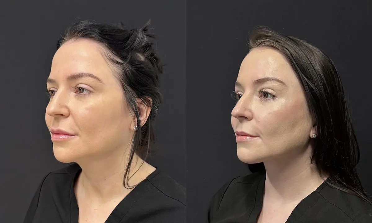 Left oblique, before and after