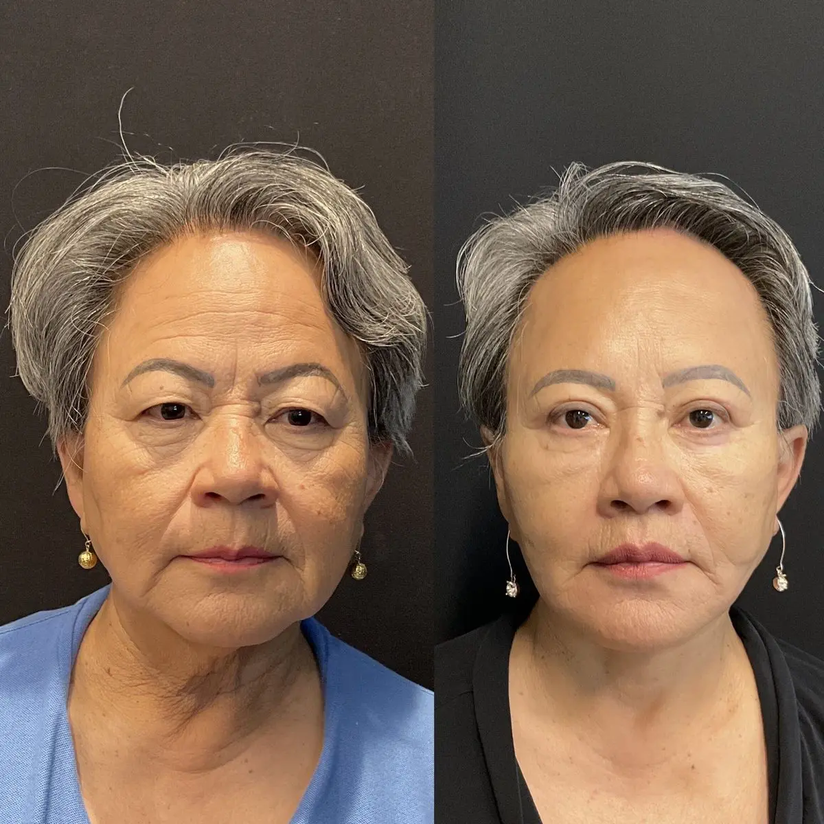 Traditional facelift front view - patient in her 60s - Dr. Adam Weinfeld Austin