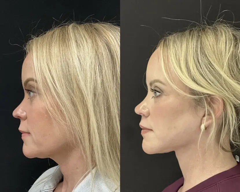 Front view, before and after