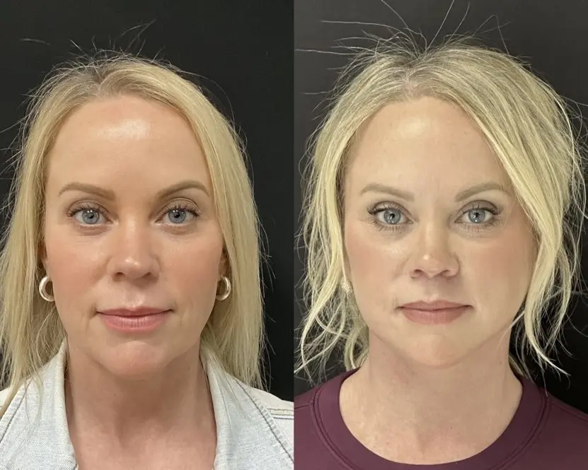 Side view, before and after