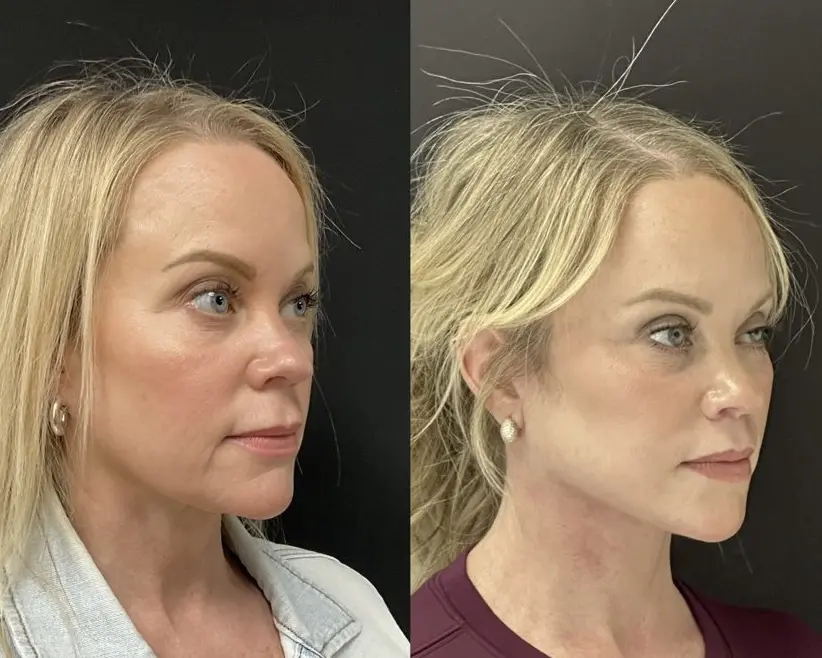 Facelift preview — oblique view
