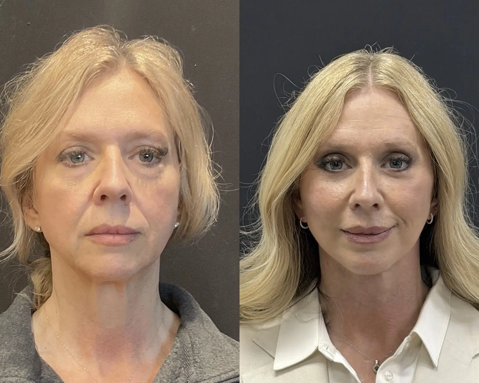 Front view, before and after