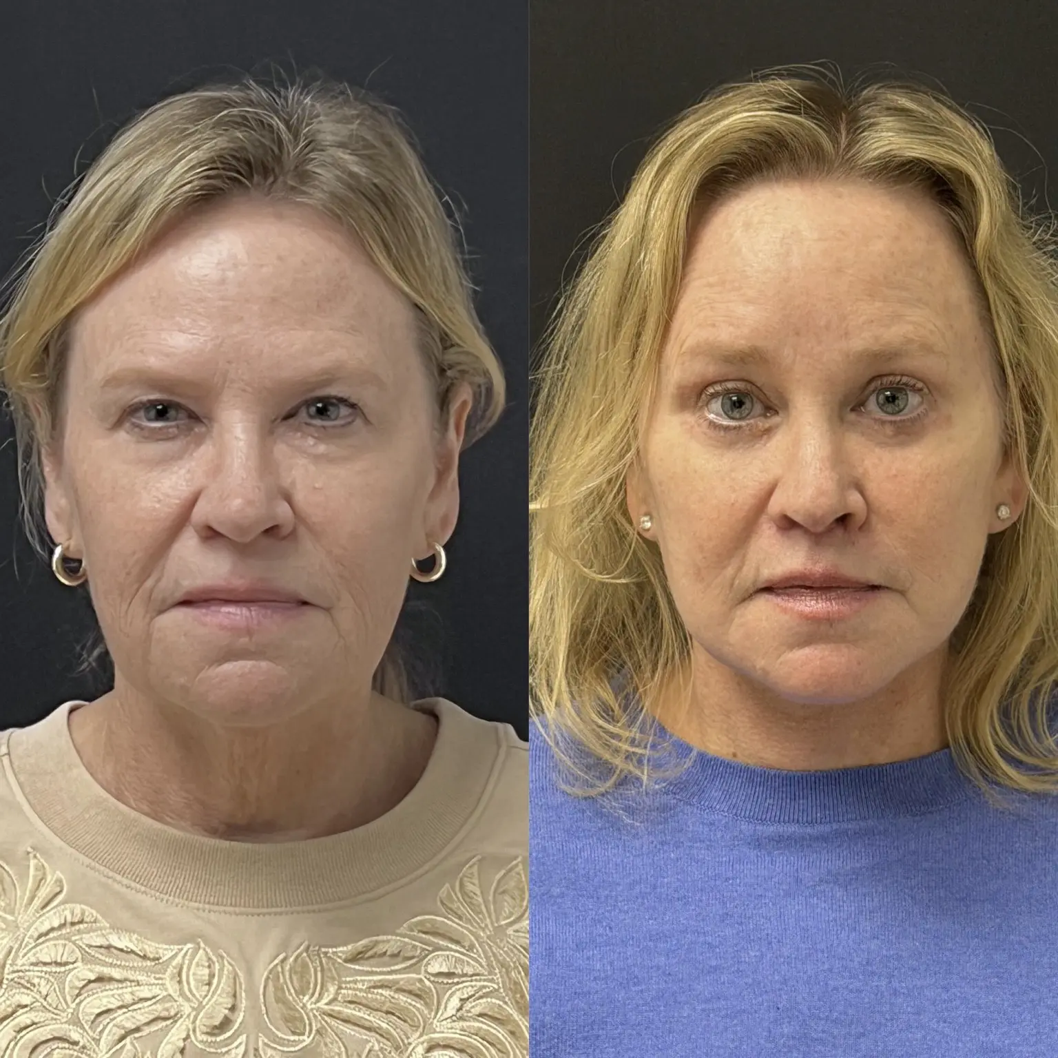 Traditional facelift front view - patient in her 50s - Dr. Adam Weinfeld Austin