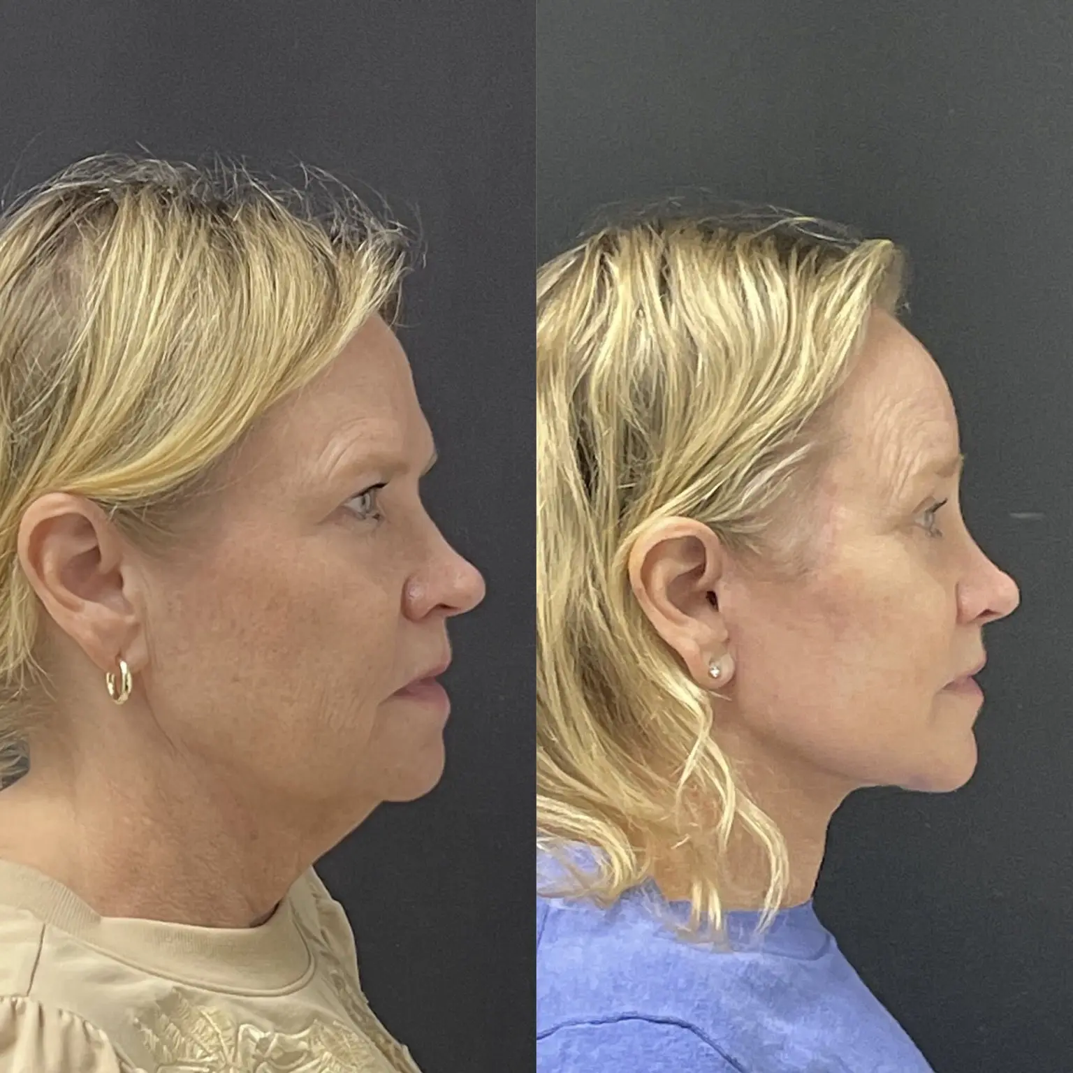 Traditional facelift side view - patient in her 50s - Dr. Adam Weinfeld Austin