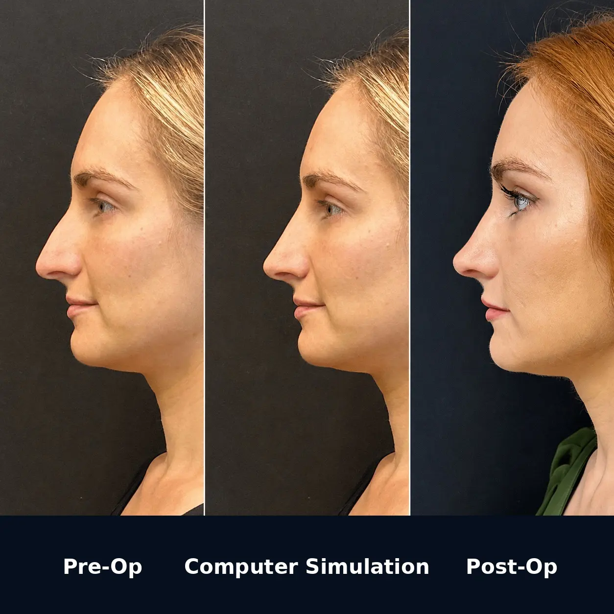 Computer simulation predicting rhinoplasty results
