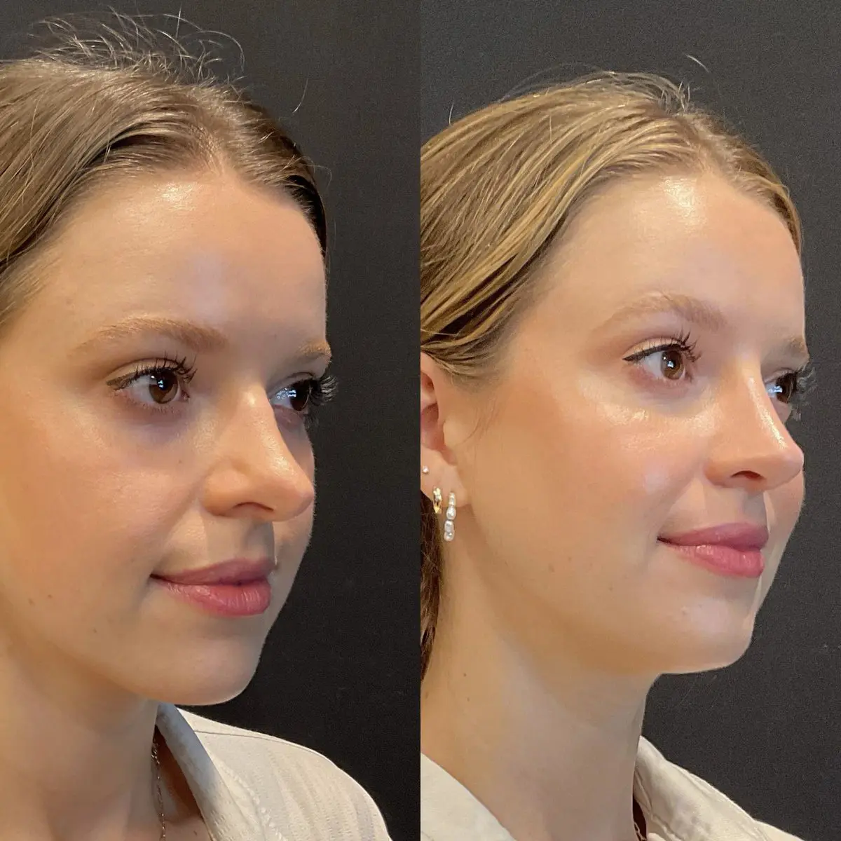 Complex revision rhinoplasty result