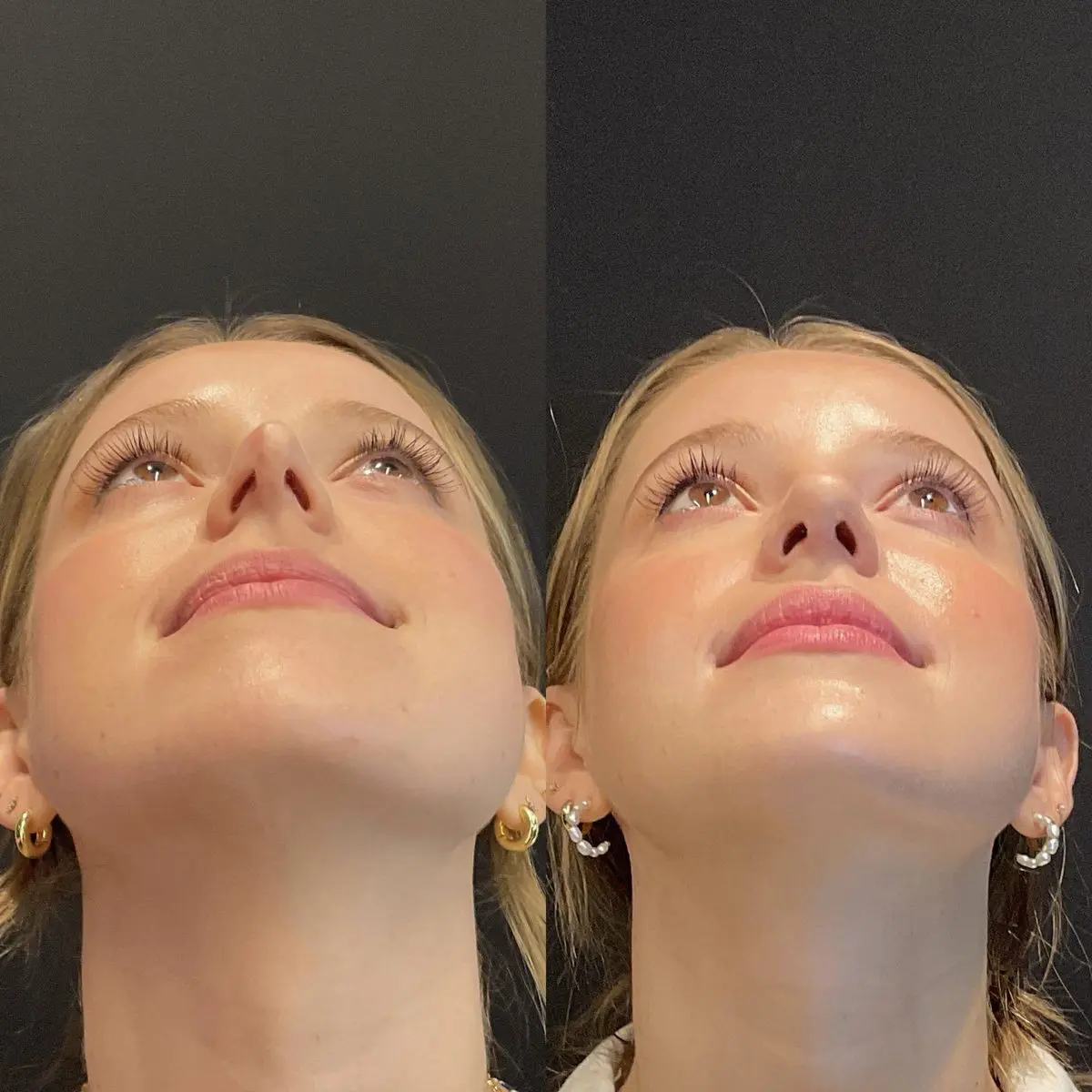 Complex revision rhinoplasty result