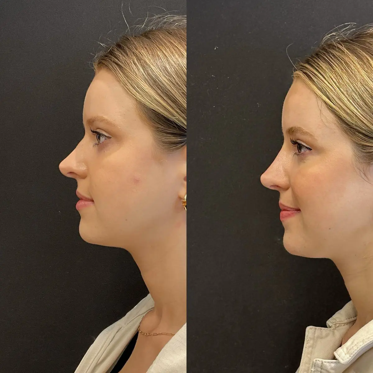 Complex revision rhinoplasty result