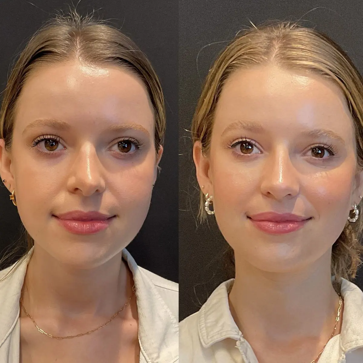 Complex revision rhinoplasty result