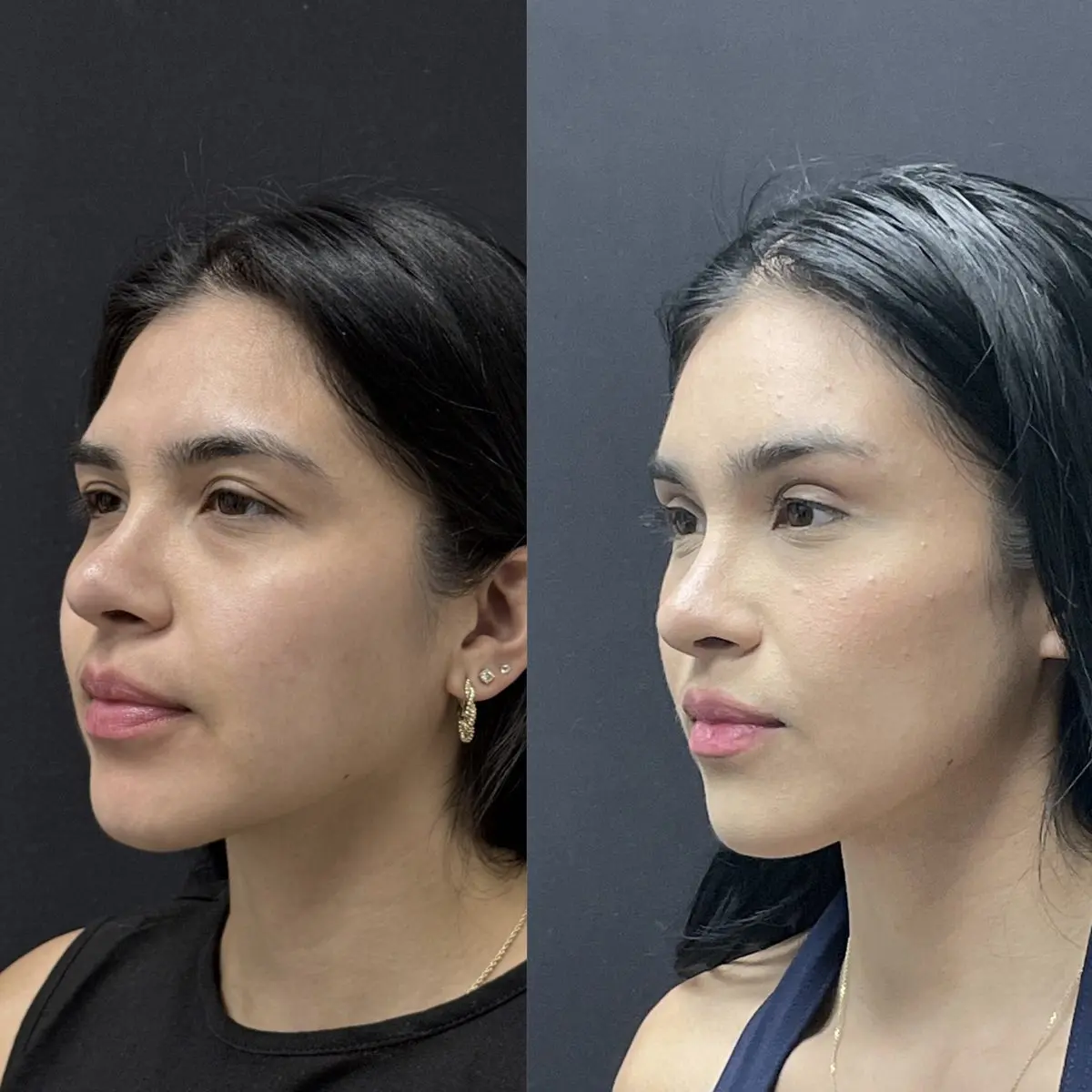 Hidden scar upper facelift oblique view - patient in her 20s - Dr. Adam Weinfeld Austin
