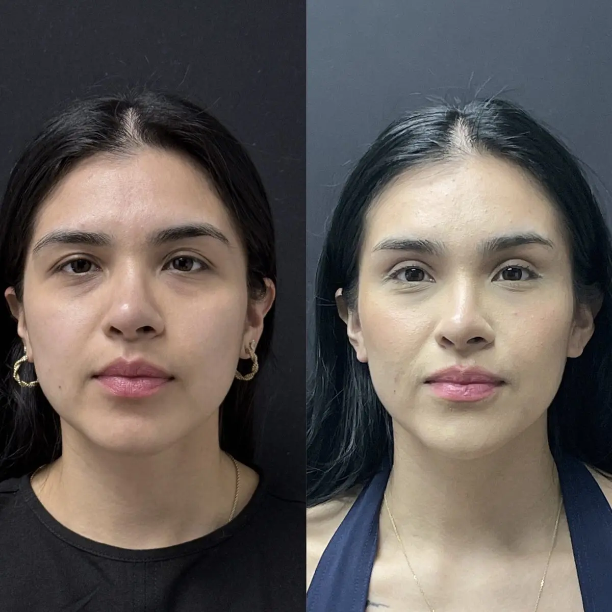 Hidden scar upper facelift front view - patient in her 20s - Dr. Adam Weinfeld Austin