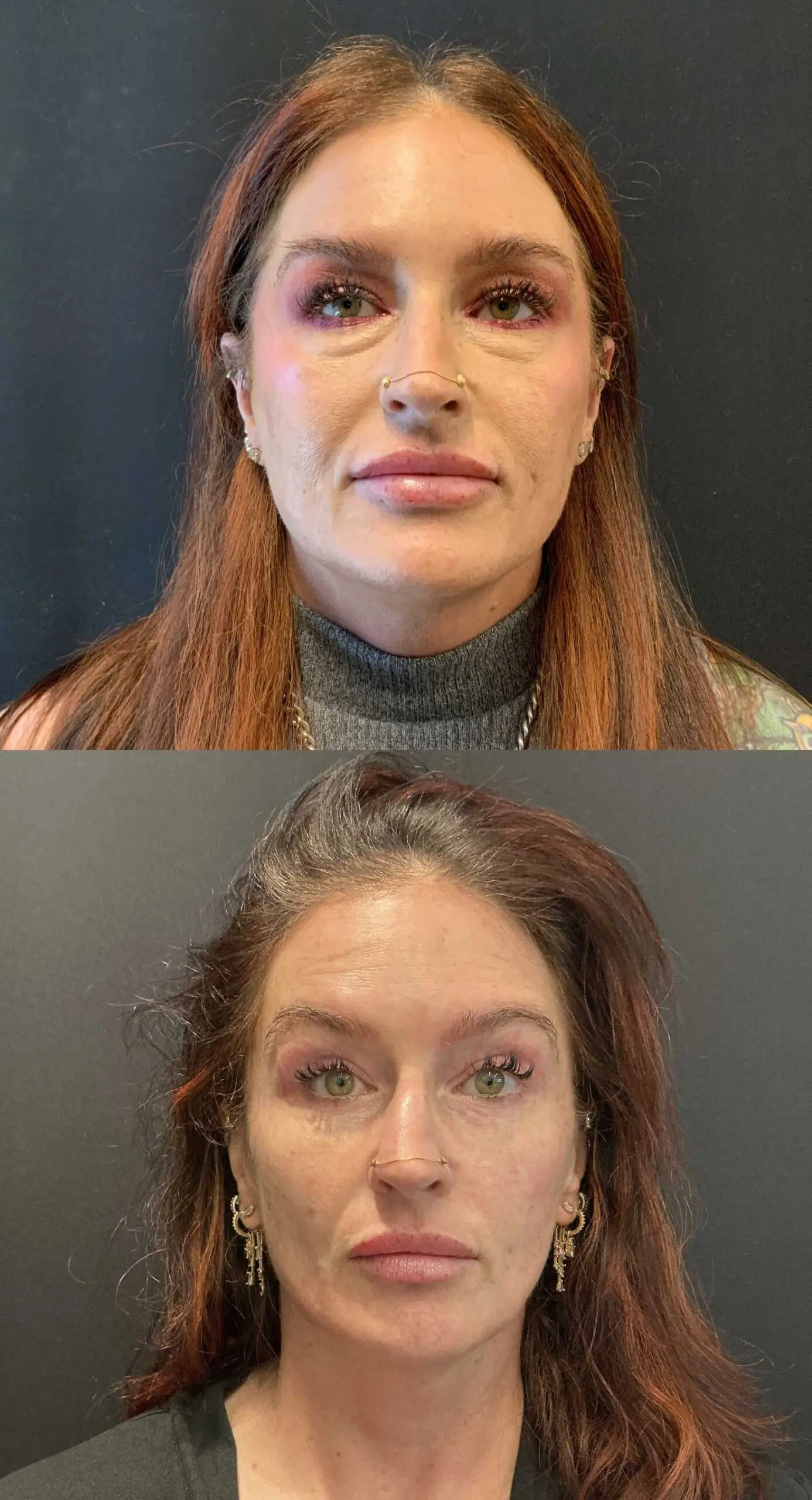 Before and after three-dimensional hidden scar upper facelift with upper and lower blepharoplasty, front view, four months