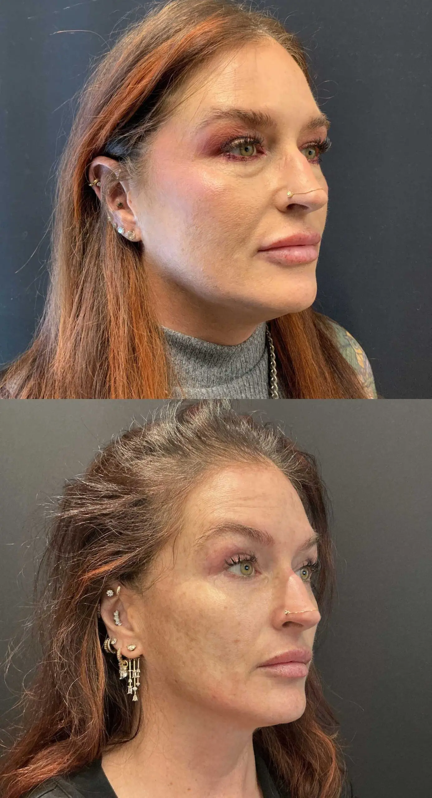 Oblique view comparison before and after three-dimensional hidden scar upper facelift with upper and lower blepharoplasty, four months
