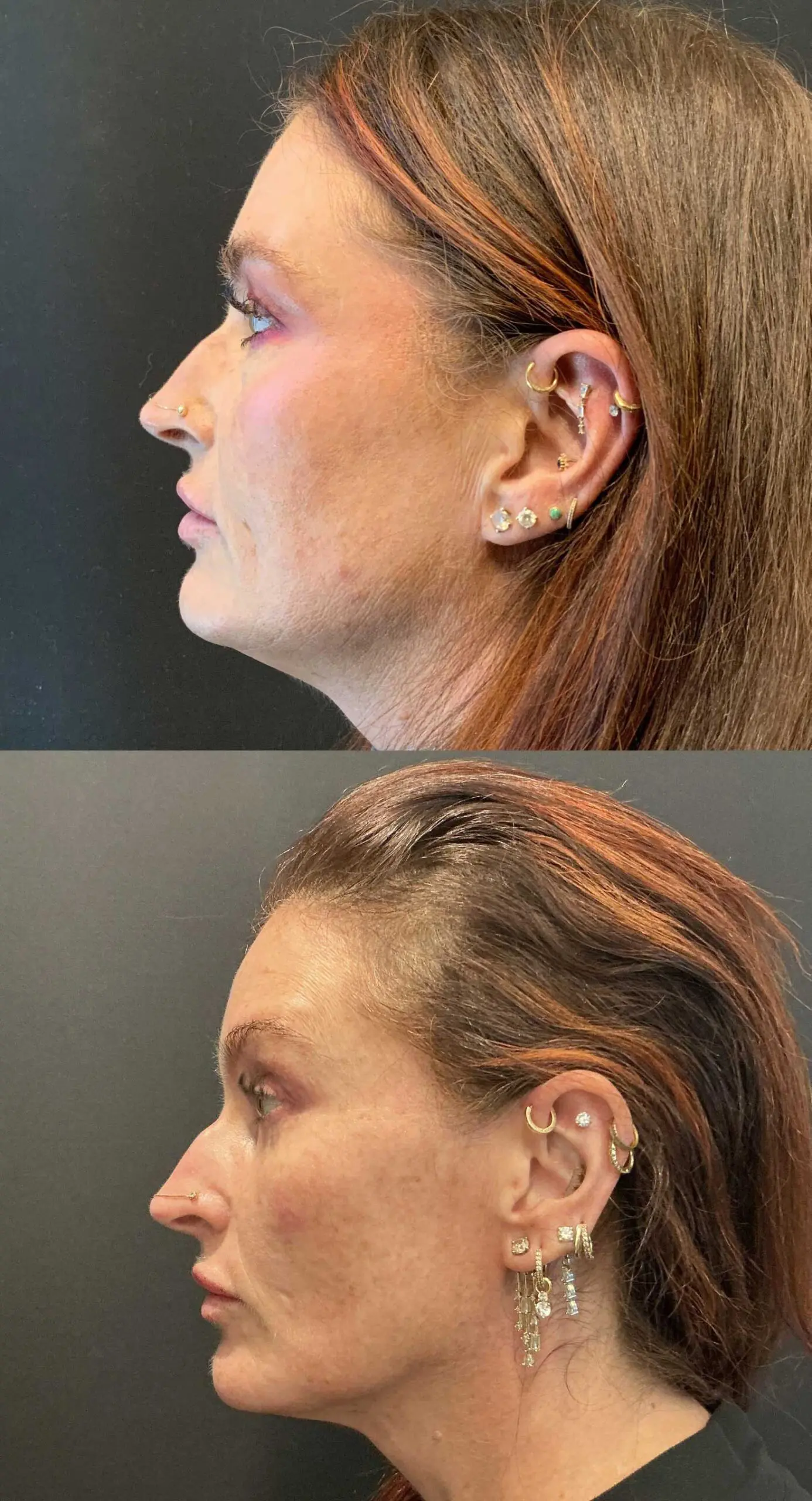 Side view comparison before and after three-dimensional hidden scar upper facelift with upper and lower blepharoplasty, four months
