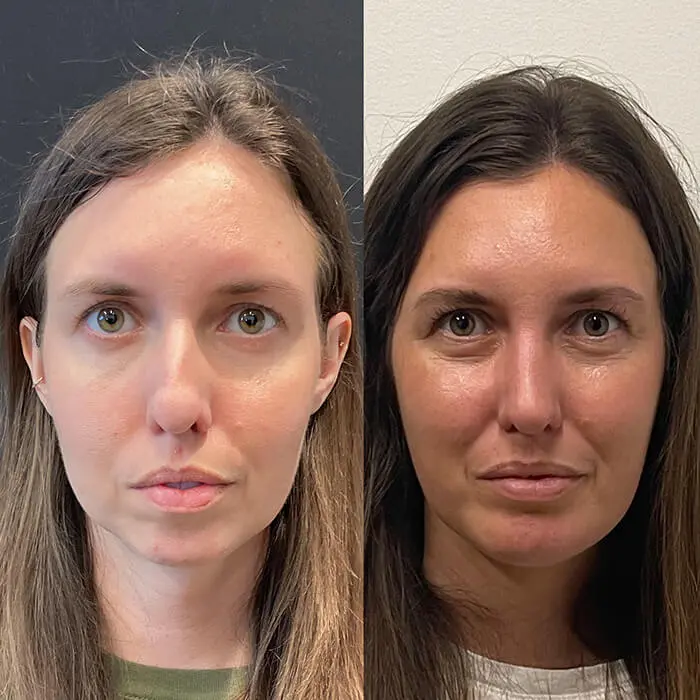 Rhinoplasty Before and After Patient 3