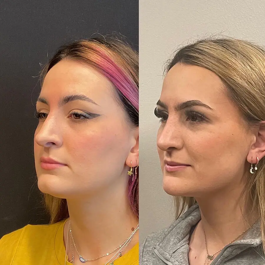 Revision Rhinoplasty Before and After Patient 1