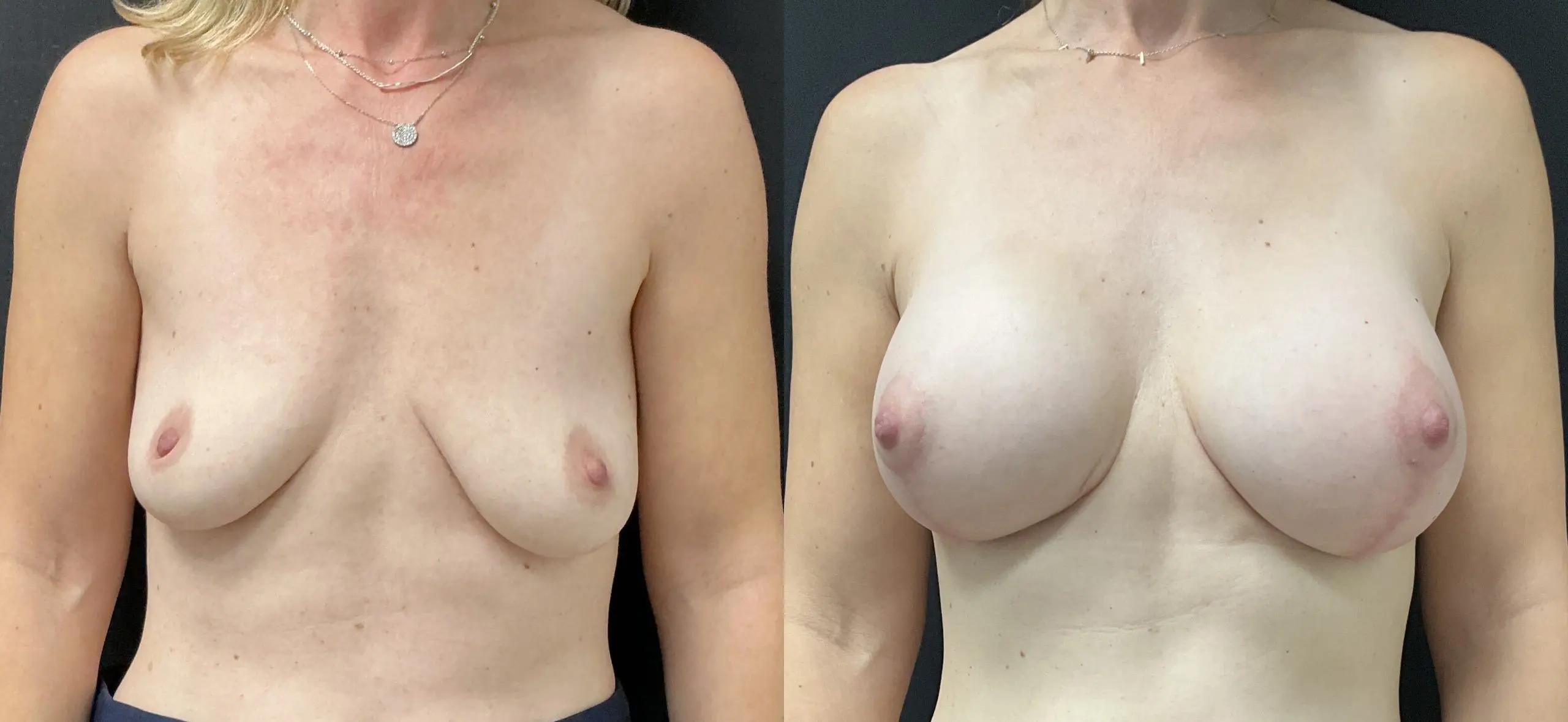 Breast Augmentation Before and After Patient 1