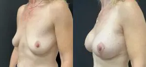 Breast Augmentation Before and After Patient Thumbnail 2