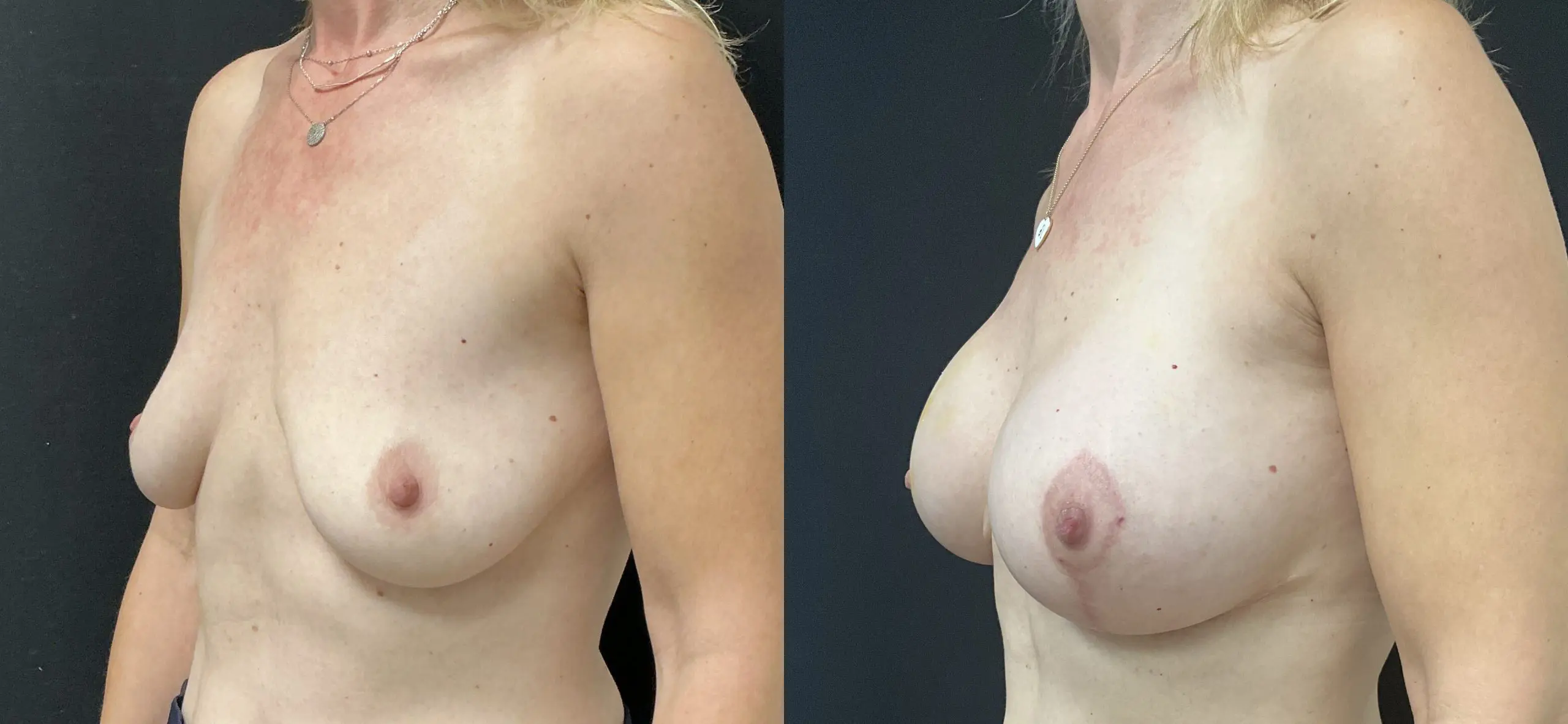 Breast Augmentation Before and After Patient 2
