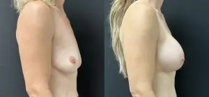 Breast Augmentation Before and After Patient Thumbnail 3