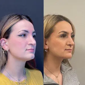 Revision Rhinoplasty Before and After Patient Thumbnail 4