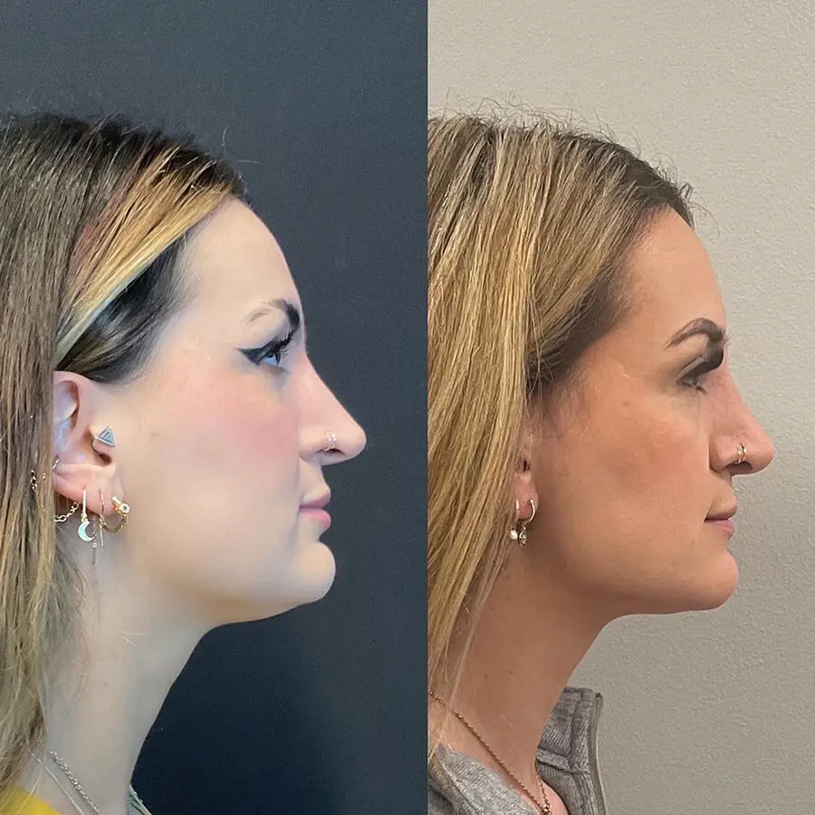 Revision Rhinoplasty Before and After Patient 5