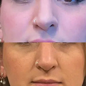 Revision Rhinoplasty Before and After Patient Thumbnail 6