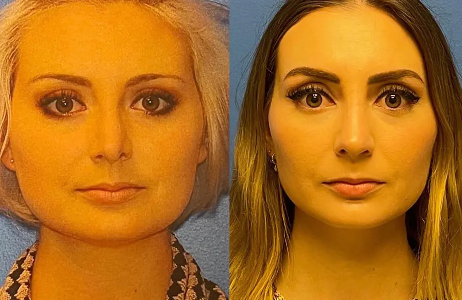 Revision Rhinoplasty Before and After Patient 1