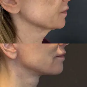 Facelift & Neck Lift Before and After Patient Thumbnail 5