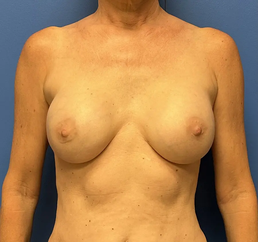 Breast Reconstruction Before and After Patient 1