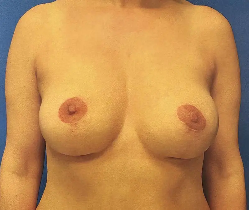 Breast Reconstruction Before and After Patient 1