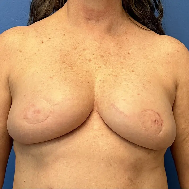 Breast Reconstruction Before and After Patient 1