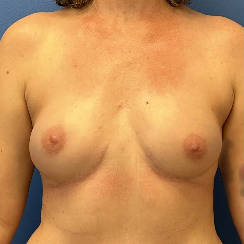 Breast Reconstruction Before and After Patient 1