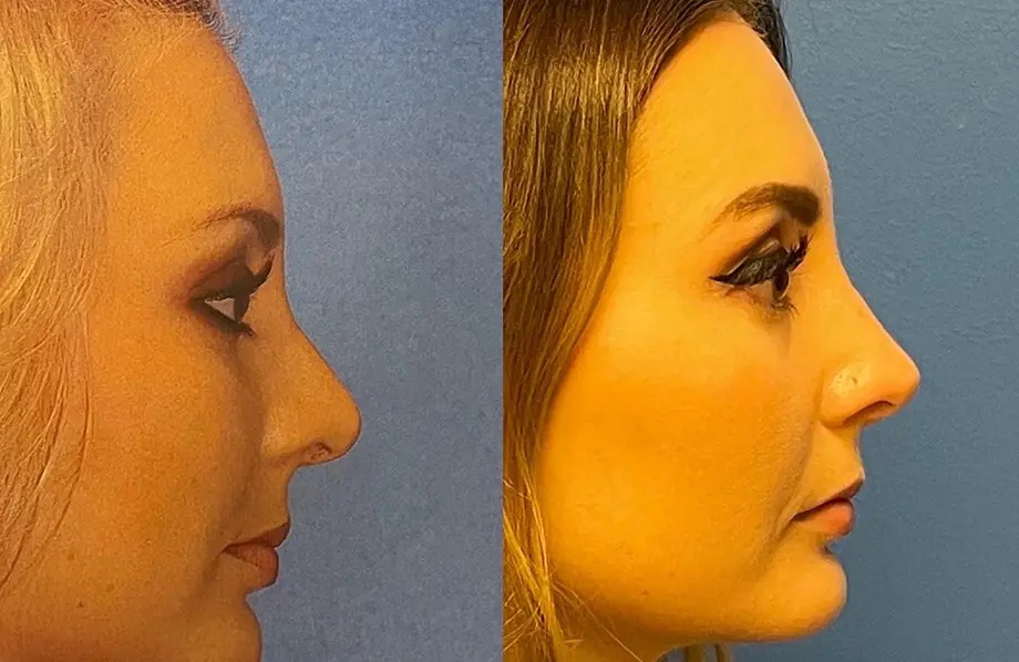 Revision Rhinoplasty Before and After Patient 3