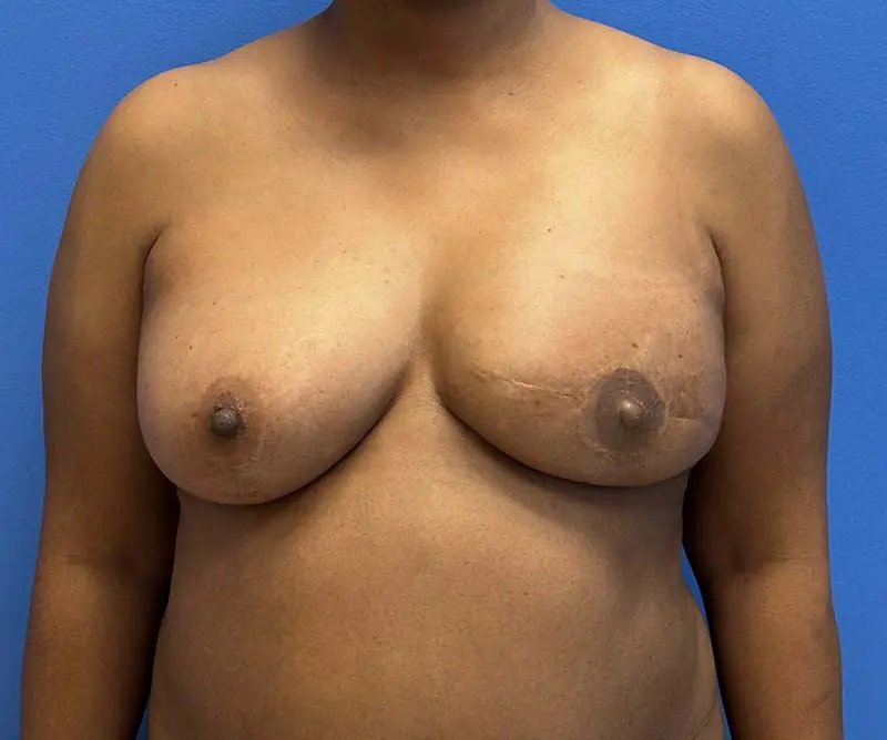 Breast Reconstruction Before and After Patient 2