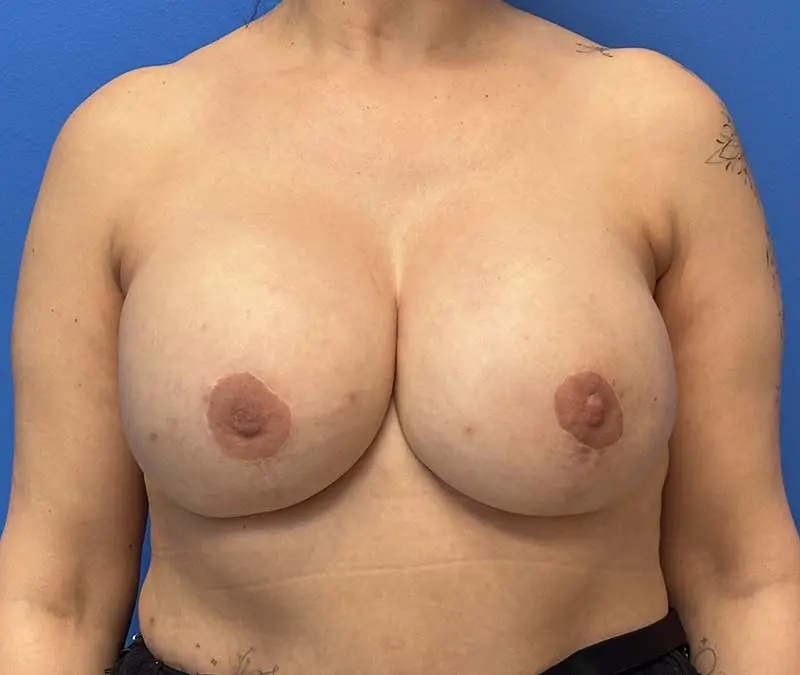 Breast Reconstruction Before and After Patient 2