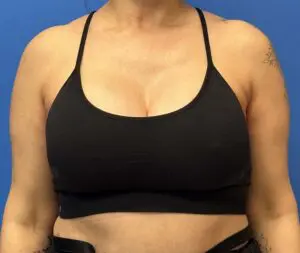 Breast Reconstruction Before and After Patient Thumbnail 3